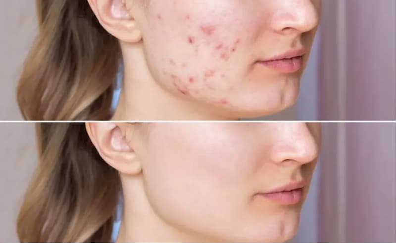 Microneedling Gone Wrong Before and After 1 treatment