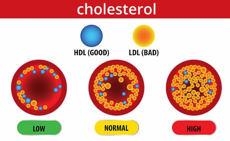 What Is High Cholesterol?