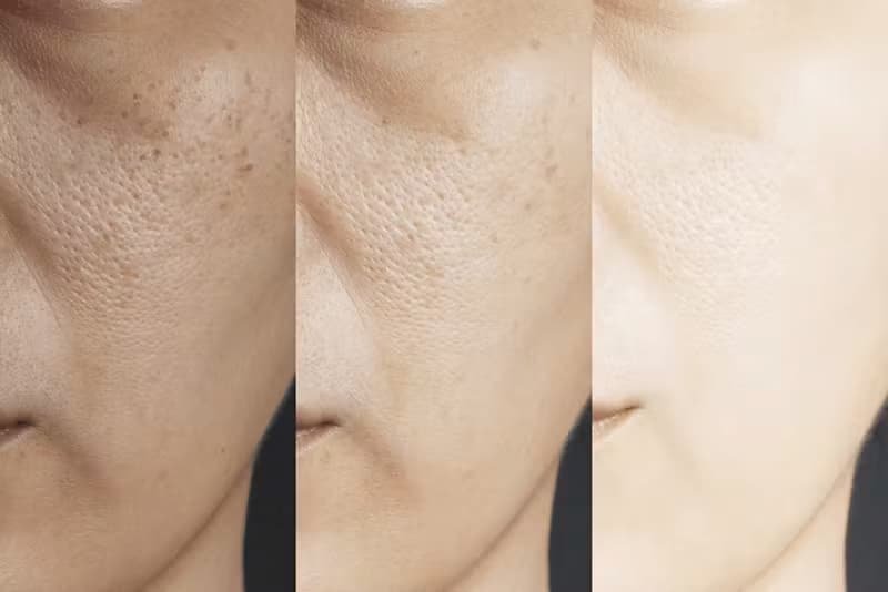 Tretinoin Before and After: Uneven Skin Tone