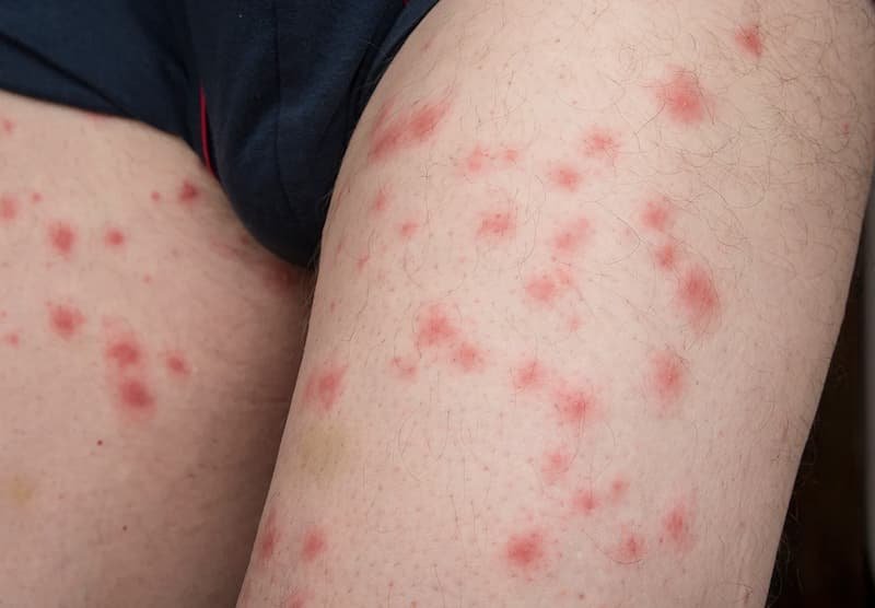 Bed Bug Bites