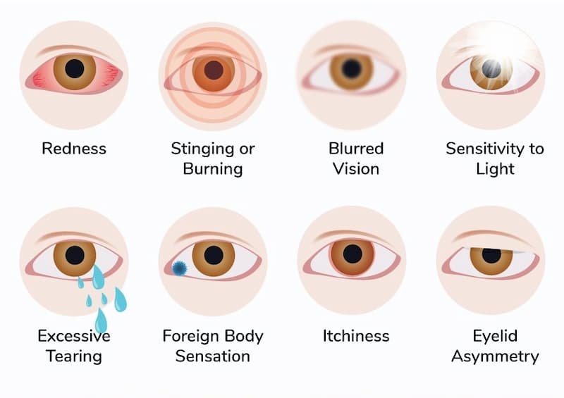 Dry eye syndrome