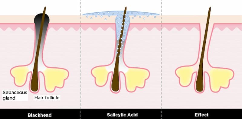 How Does Salicylic Acid Help Your Skin?