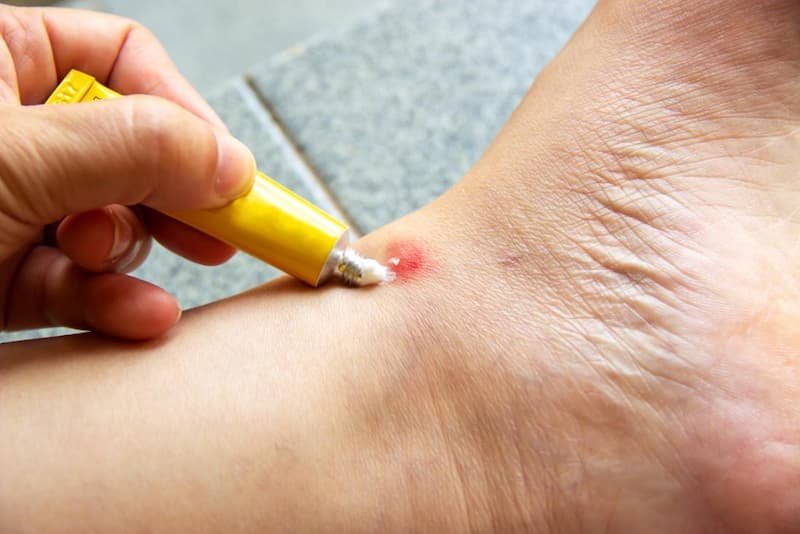 How to treat mosquito bites on leg