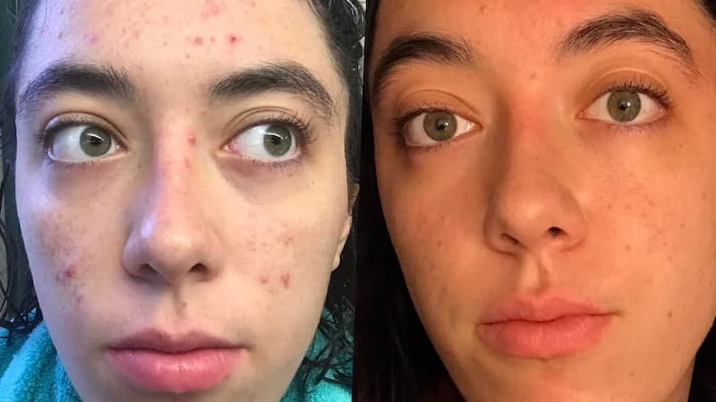 What Is Tretinoin?